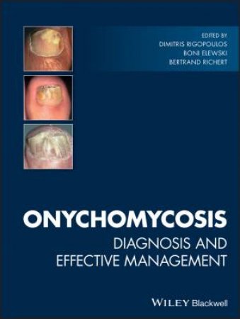 Onychomycosis by Dimitris Rigopoulos