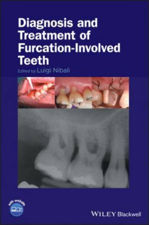 Diagnosis And Treatment Of Furcation-Involved Teeth by Luigi Nibali